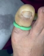 Anillo-o-torniquete-Hemostatico-Control-Preciso-de-Hemorragias